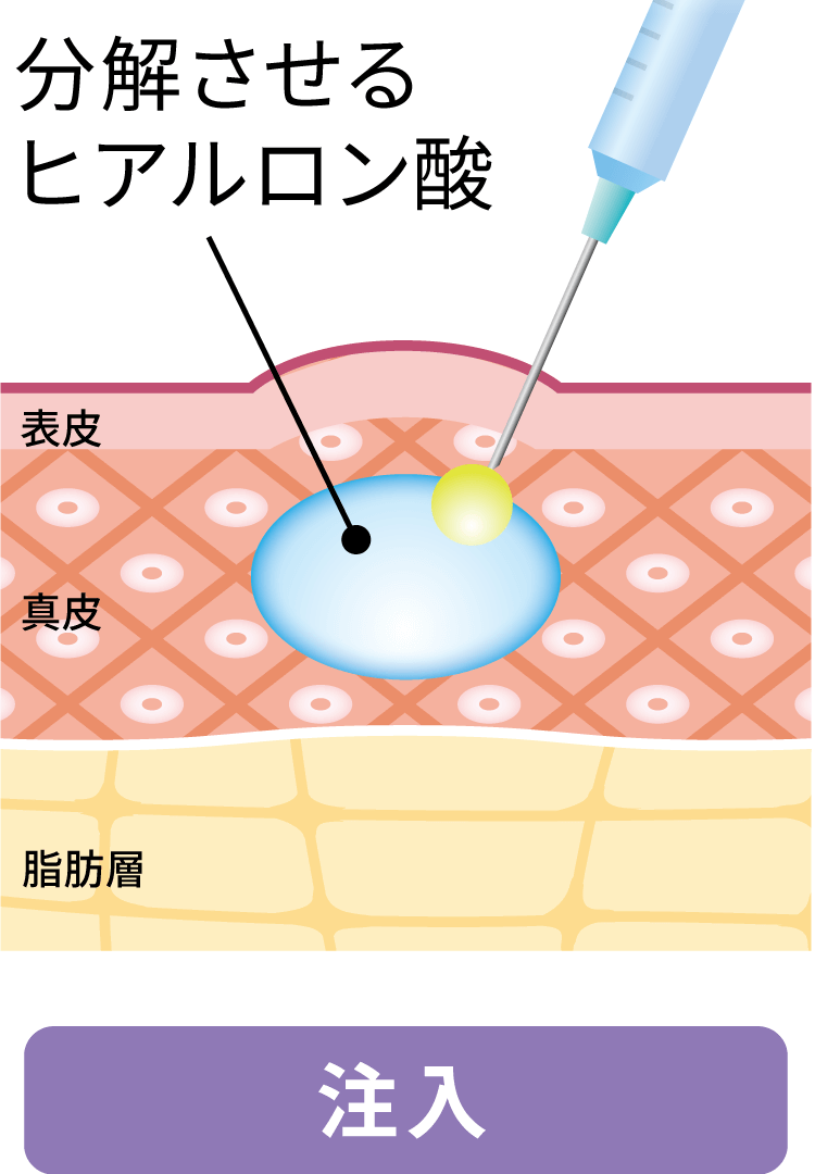 1.ヒアルロニダーゼの注入